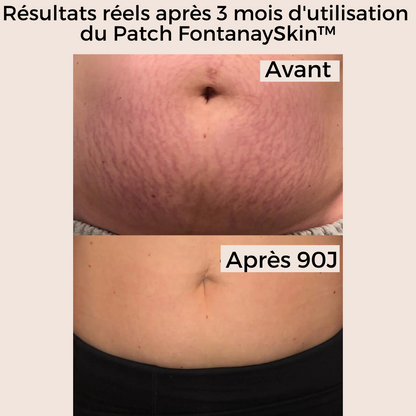 Patchs Corps Vergetures et Cellulite Réutilisables FontanaySkin™
