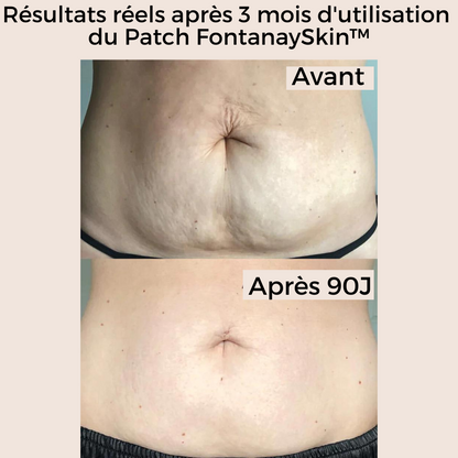 Patchs Corps Vergetures et Cellulite Réutilisables FontanaySkin™