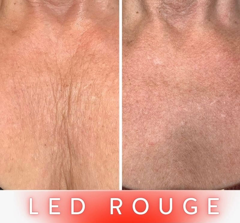 Masque LED Anti-Âge Pro - Cou et Décolleté