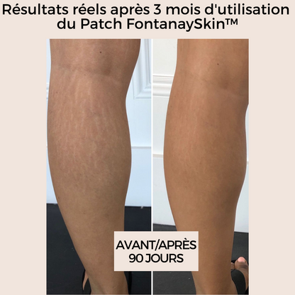 Patchs Corps Vergetures et Cellulite Réutilisables FontanaySkin™